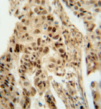 Image: Immunohistochemical analysis of pulmonary adenocarcinoma stained for ASCL1 (Photo courtesy of LifeSpan BioSciences).